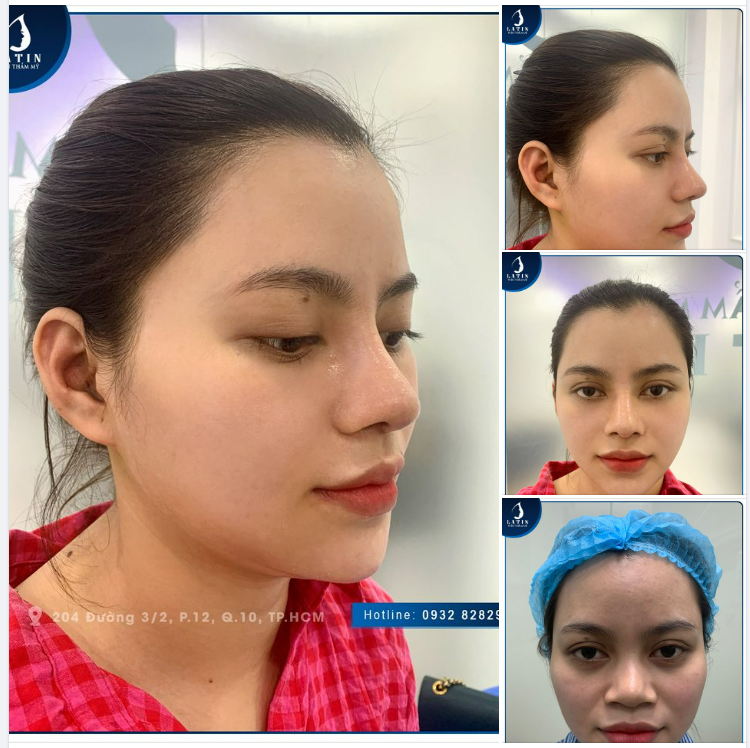 Feedback Mũi cấu trúc 10 ngày siêu nét, thần thái thay đổi bất ngờ