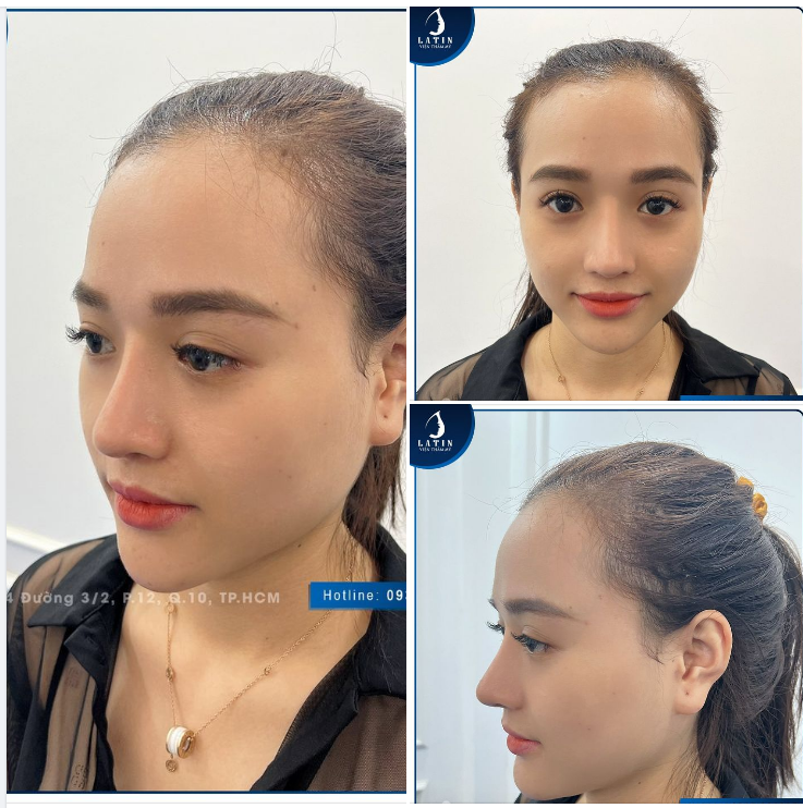 FEEDBACK Mũi cấu trúc sửa lại sau 2 năm
