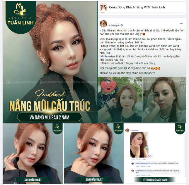 FEEDBACK NÂNG MŨI CẤU TRÚC Và DÁNG MŨI HIỆN TẠI SAU 2 NĂM