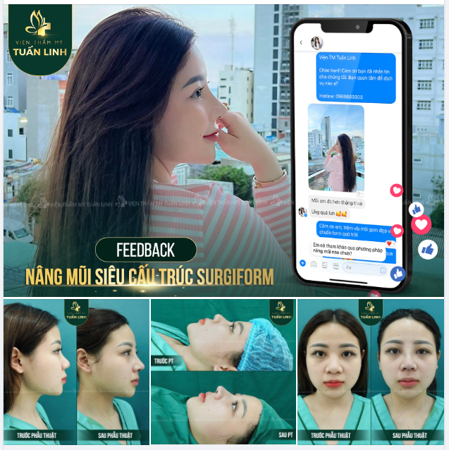 FEEDBACK NÂNG MŨI SIÊU CẤU TRÚC SURGIFORM