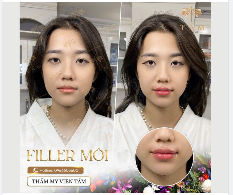 FILLER MÔI 