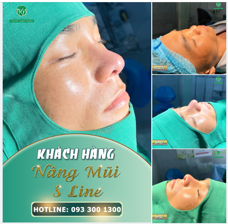 FORM MŨI CẤU TRÚC S LINE CHO KH NAM