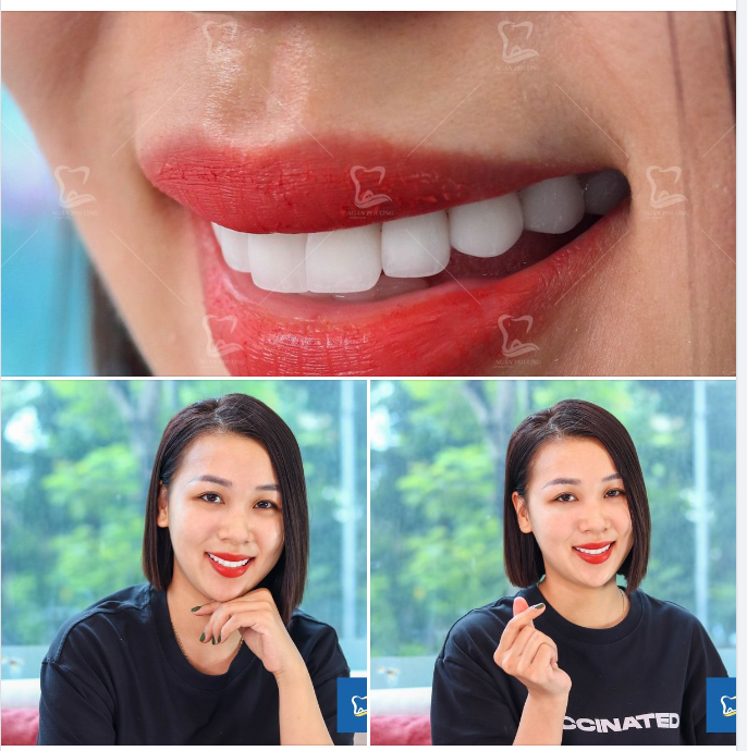 Form răng duyên dáng, thành quả xứng đáng cho nụ cười