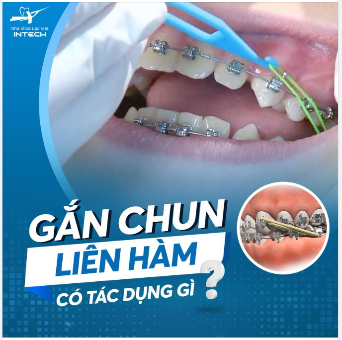 GẮN CHUN LIÊN HÀM CÓ TÁC DỤNG GÌ?