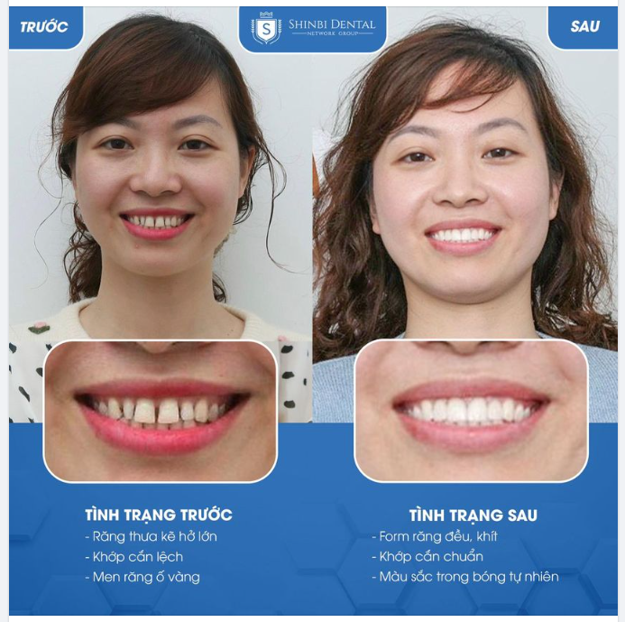 GẠT BỎ NỖI TỰ TI VỚI HÀM RĂNG THƯA, TÌM LẠI MÌNH Ở PHIÊN BẢN RẠNG RỠ NHẤT
