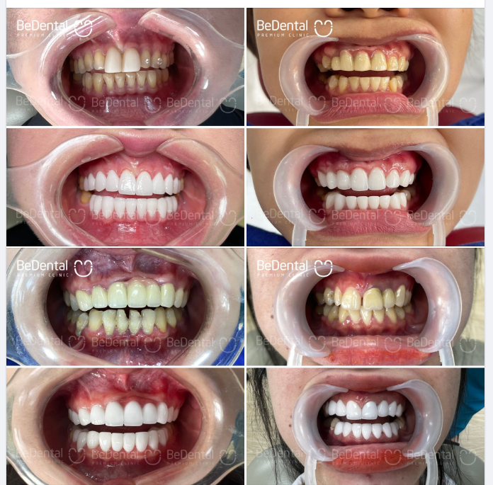 Giải cứu các case phủ sứ, bọc sứ nơi khác bị hỏng