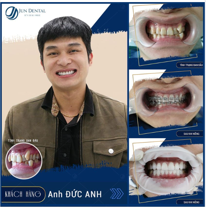 GIẢI CỨU HÀM RĂNG KHẤP KHỂNH NGAY BÂY GIỜ!!!