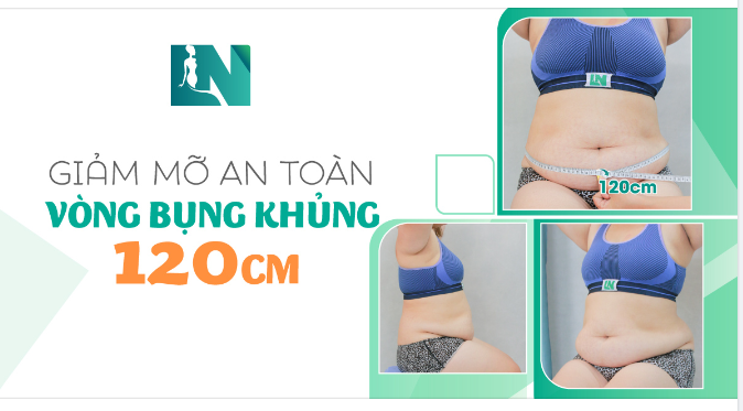 GIẢM MỠ AN TOÀN CHO VÒNG BỤNG KHỦNG 120CM