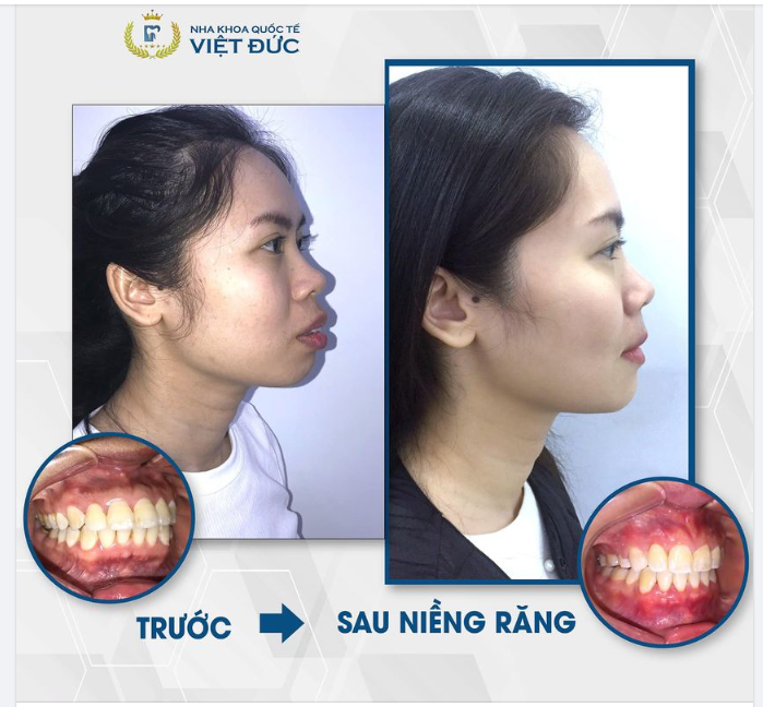 Góc nghiêng thần thánh mà đồng niềng nào cũng mơ ước