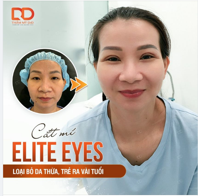 GƯƠNG MẶT TRẺ RA VÀI TUỔI SAU KHI THỰC HIỆN CẮT MÍ ELITE EYES