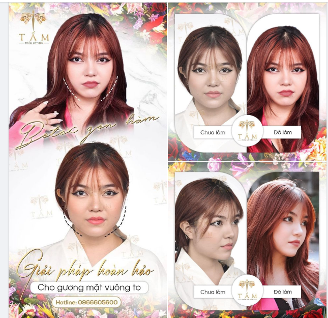 HÀM THON GỌN - CHUẨN HOT GIRL CÙNG BOTOX GỌN HÀM