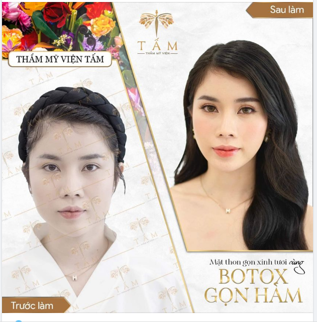 HÀM THON GỌN SẮC NÉT HƠN CHỈ SAU 2 - 3 TUẦN NHỜ BOTOX GỌN HÀM