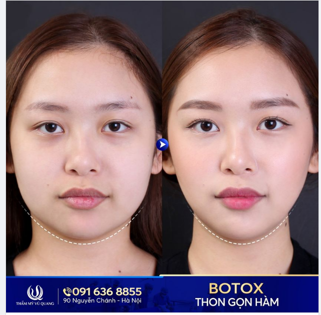 Hàm thon gọn, trọn nét duyên Cải thiện gương mặt không phẫu thuật với Tiêm Botox thon gọn hàm.