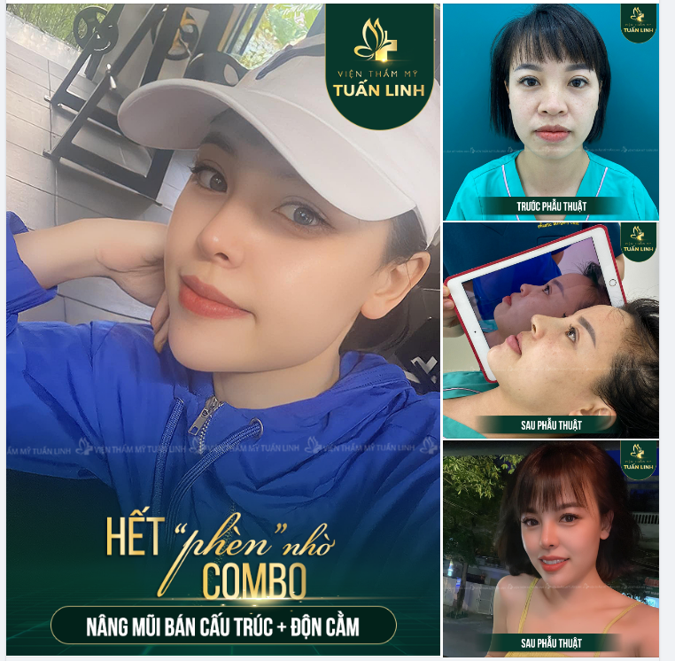 HẾT ''PHÈN NHỜ COMBO NÂNG MŨI BÁN CẤU TRÚC + ĐỘN CẰM
