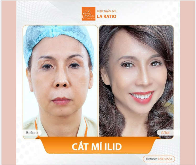 Hình ảnh chị Ngọc phượng sau khi sử dụng dịch vụ cắt mí iLid.