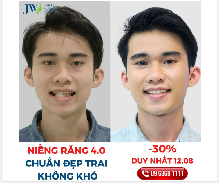 HÓA NAM THẦN CHỈ CẦN NIỀNG RĂNG 4.0 TẠI JW