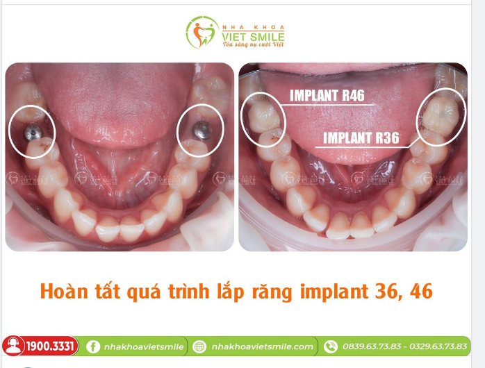 HOÀN TẤT QUÁ TRÌNH LẮP RĂNG IMPLANT R36,46