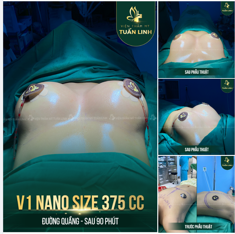 HOÀN THÀNH CA NÂNG V1 SAU 90 PHÚT ĐƯỢC THỰC HIỆN TẠI BỆNH VIỆN.
