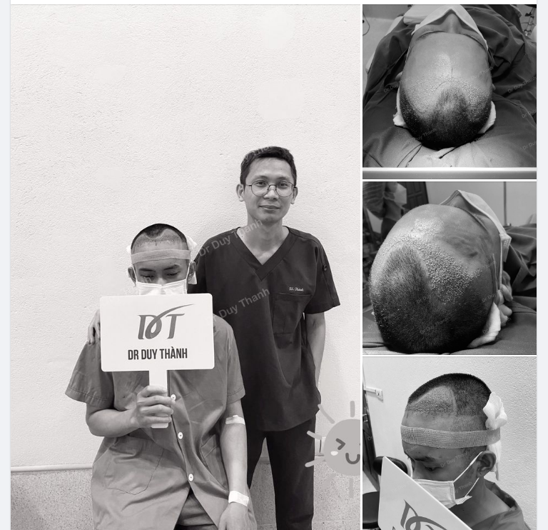 HOÀN THÀNH TÁC PHẨM CẤY 1300 NANG TÓC CHO BOY THANH HÓA