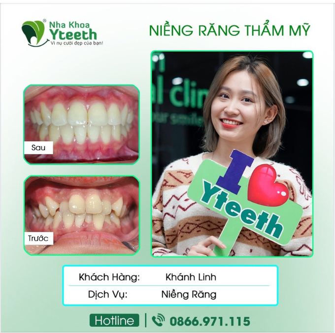 HỐI HẬN SAU KHI NIỀNG RĂNG???