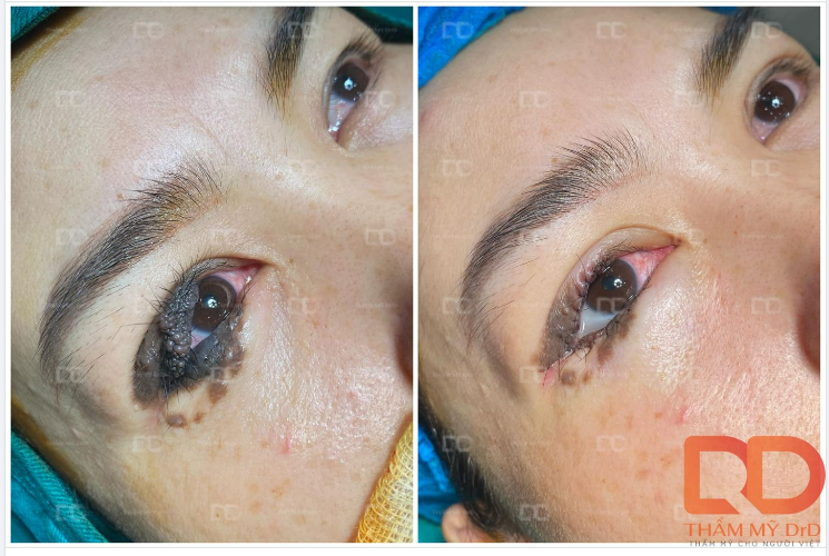 Hôm nay ngoài những ca cắt mí thông thường, bác sĩ Hồng Vân còn thực hiện một ca giải phẫu bệnh khắc phục Nevi sắc tố vùng mi mắt.