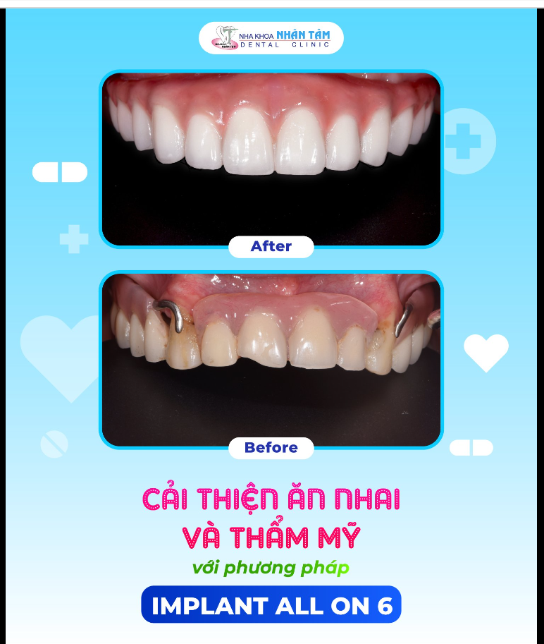 HƠN 10 NĂM DÙNG HÀM THÁO LẮP, NAY CÓ THỂ ĂN NGON MIỆNG VỚI IMPLANT