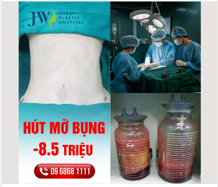 HÚT MỠ BỤNG - VÔ TƯ THẢ DÁNG KHÔNG CẦN PHẪU THUẬT