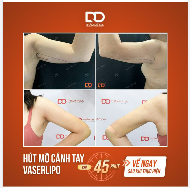 HÚT MỠ CÁNH TAY - ĐẸP NGAY TỨC THÌ KẾT QUẢ SAU 7 NGÀY CẮT CHỈ