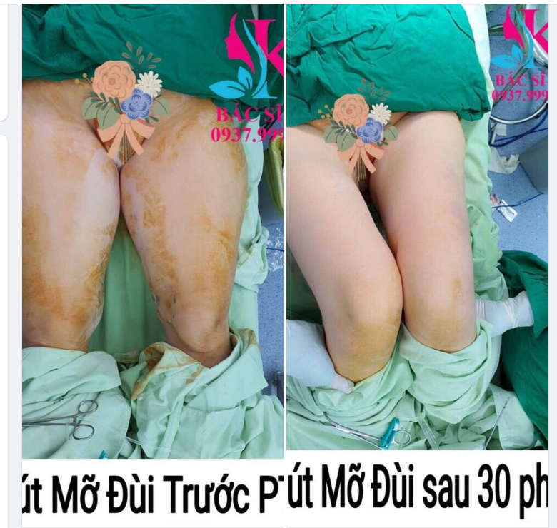 HÚT MỠ ĐÙI NỘI SOI