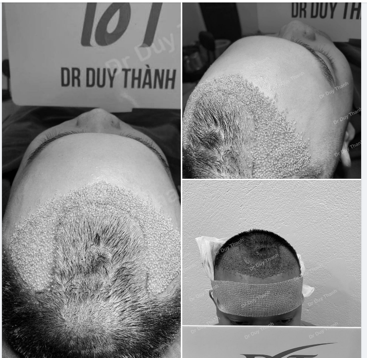 KẾT QUẢ CẤY 1750 NANG TÓC CASE THỨ 2 NGÀY HÔM NAY