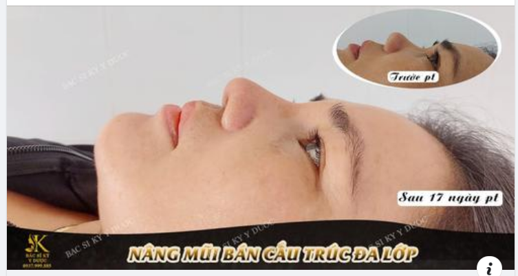 KẾT QUẢ NÂNG MŨI BÁN CẤU TRÚC ĐA LỚP CHỈ SAU 17 NGÀY