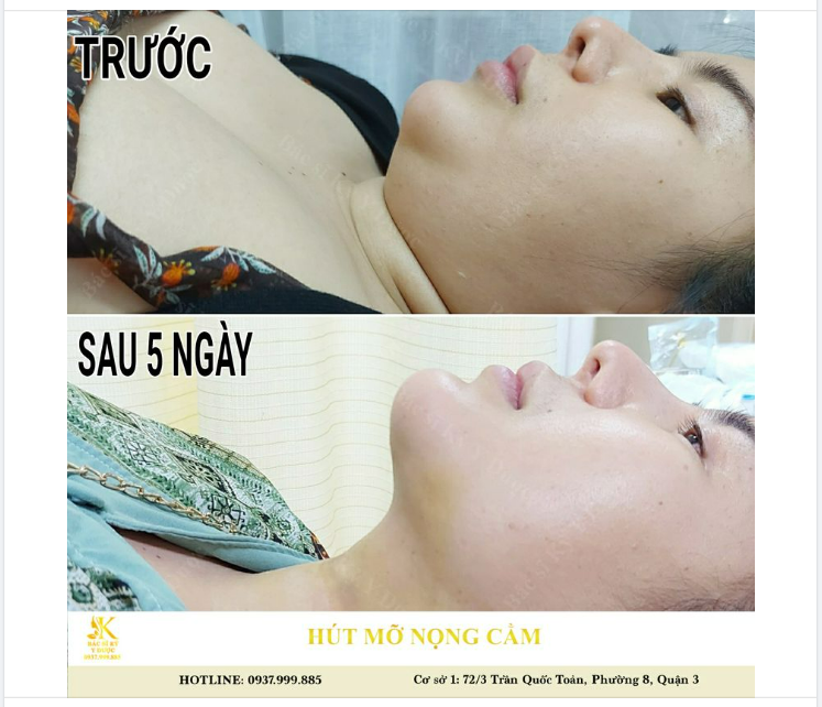 Kết quả ngạc nhiên sau 5 ngày Hút Mỡ Nọng Cằm Nanofat.