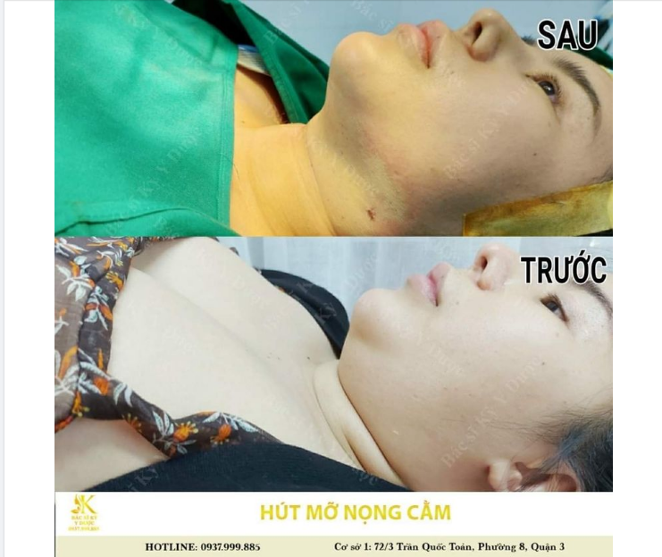Kết quả ngạc nhiên sau 5 ngày Hút Mỡ Nọng Cằm Nanofat.