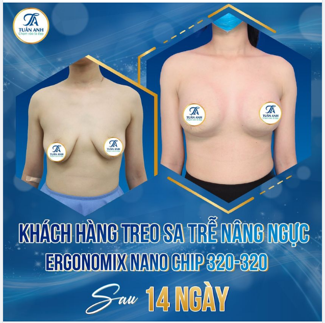 Kết quả sau 14 ngày thực hiện Combo Nâng ngực và Treo sa trễ của bạn Hà (29 tuổi)