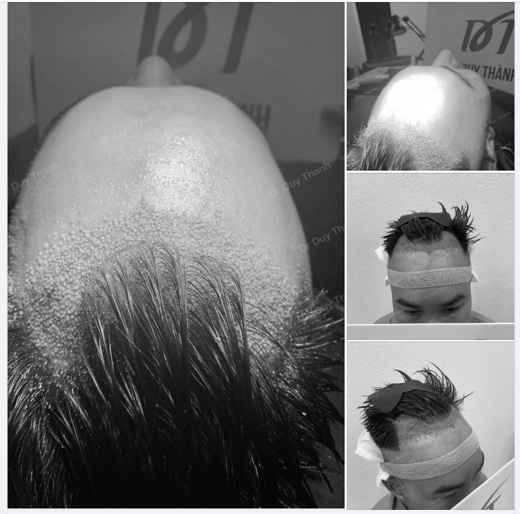 KẾT QUẢ SAU CẤY 1200 NANG TÓC CHO BOY NAM ĐỊNH 31 TUỔI