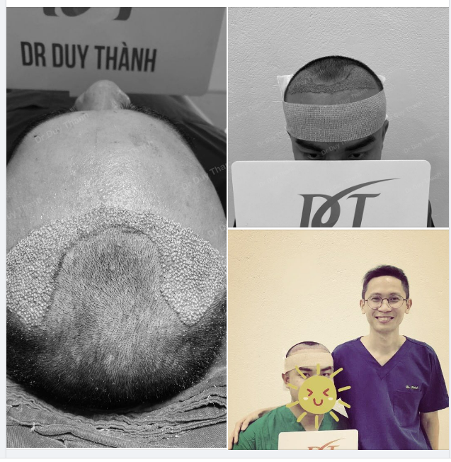 KẾT QUẢ SAU CẤY 1500 NANG TÓC KHẮC PHỤC HÓI CHỮ M CHO BOY HÀ NỘI