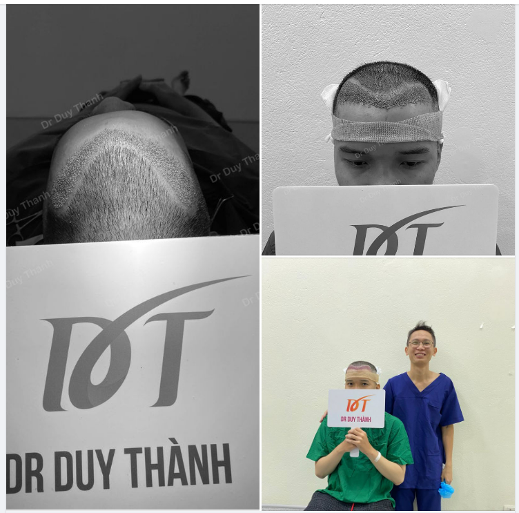 KẾT QUẢ SAU CẤY TÓC 1300 NANG HẠ ĐƯỜNG CHÂN TÓC NGÀY MƯA BÃO