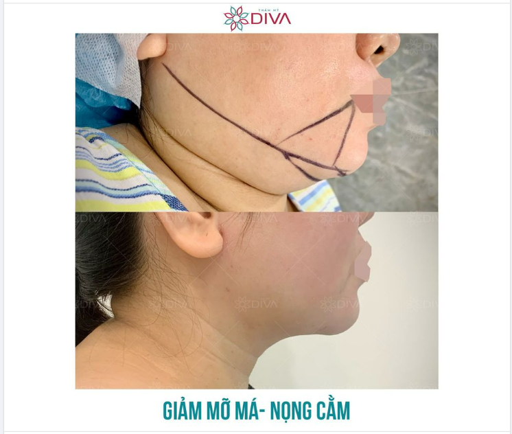 KẾT QUẢ SAU GIẢM MỠ NỌNG CẰM, GIẢM MỠ MÁ TRONG