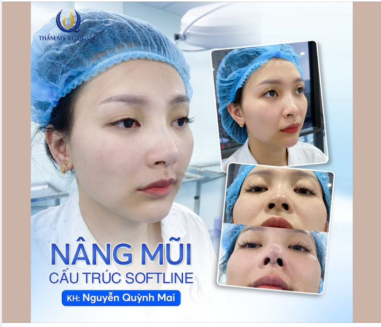 Kết quả sau khi thực hiện Nâng mũi Cấu trúc Softline - Độc quyền Dr Vũ Quang