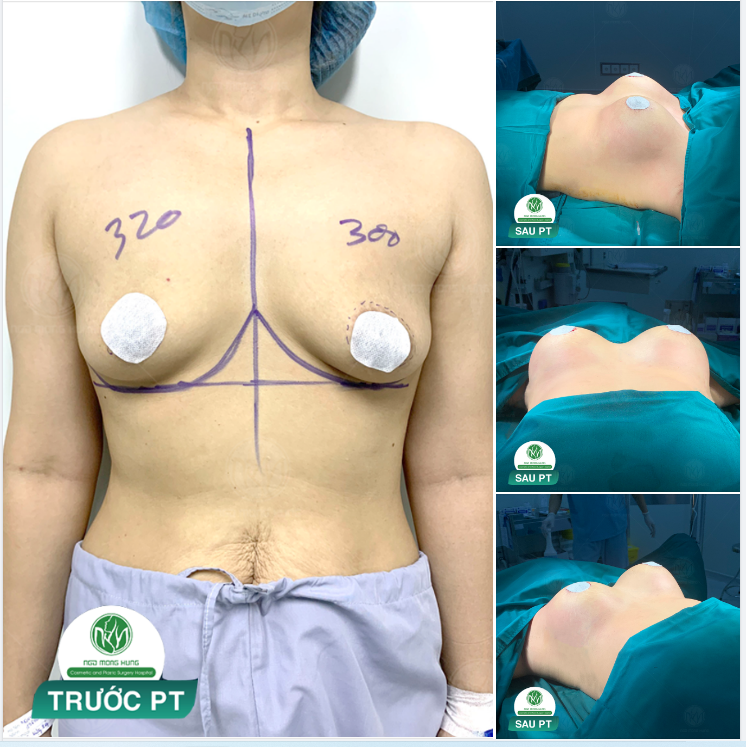 KẾT QUẢ SAU NÂNG NGỰC ĐẶT TÚI MENTOR SIZE 300 - 320CC