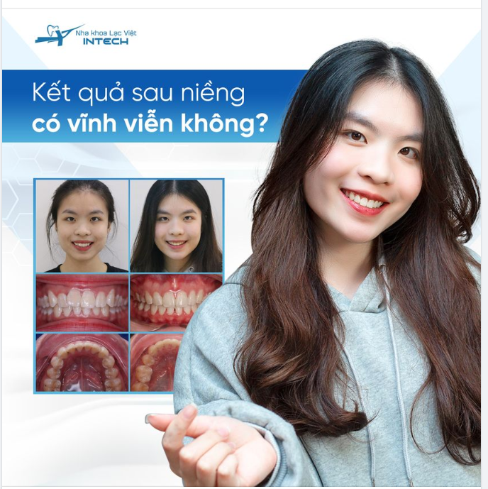 KẾT QUẢ SAU NIỀNG RĂNG CÓ VĨNH VIỄN KHÔNG?