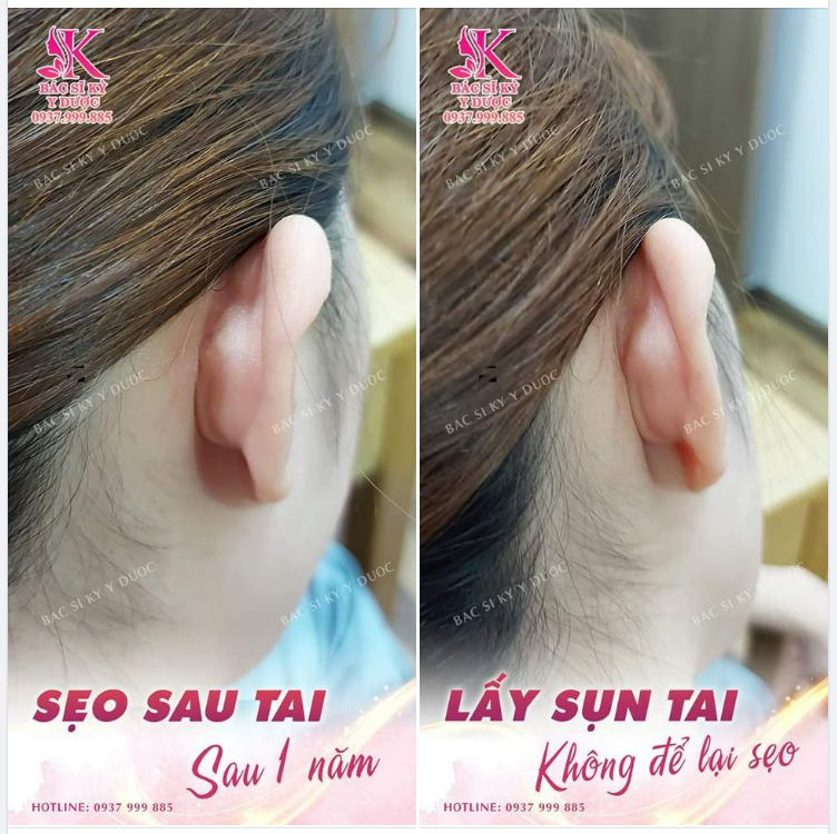 KẾT QUẢ SẸO SAU TAI KHI NÂNG MŨI 1 NĂM.