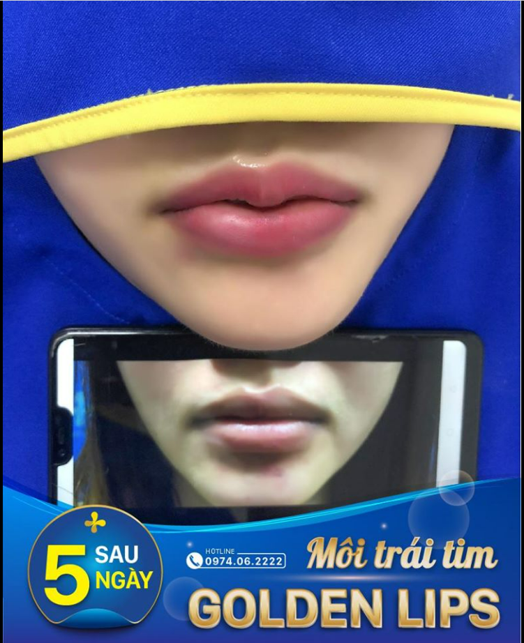 KẾT QUẢ TẠO HÌNH MÔI GOLDEN LIPS = Sở hữu ngay bờ môi trái tim mềm mại, quyến rũ.