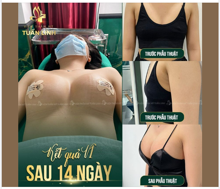 KẾT QUẢ V1 SAU 14 NGÀY TÁI KHÁM