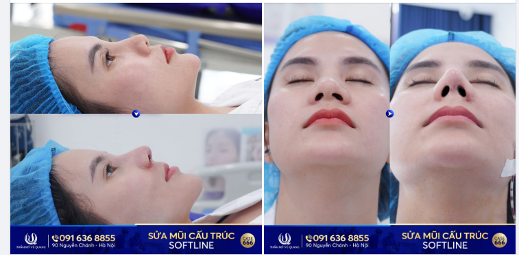 Kết quả xuất sắc ca sửa mũi cho KH đã từng tiêm filler lỗi