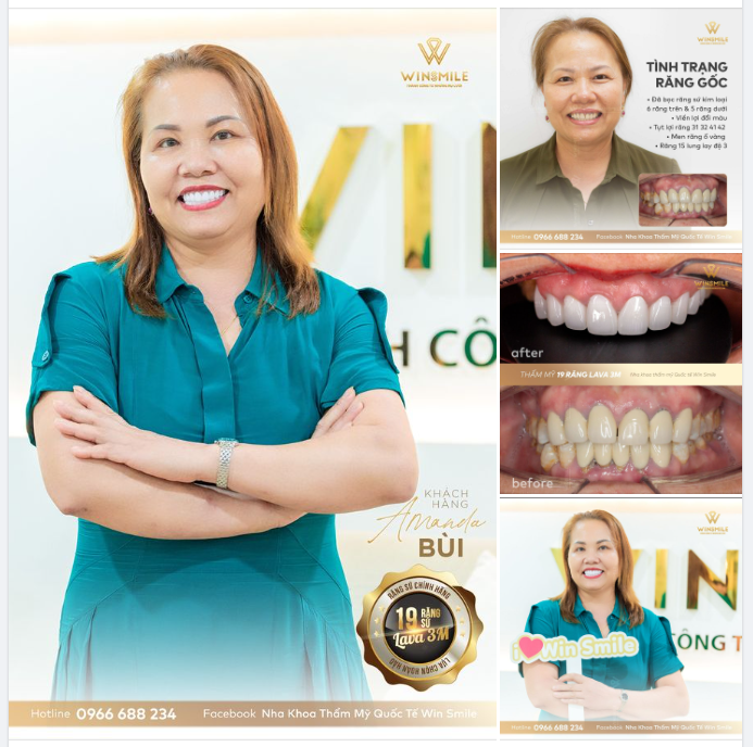 Kết quả xứng đáng của nữ khách hàng việt kiều đã chứng minh rằng giải quyết tình trạng răng miệng khiến bạn tự ti không hề khó.
