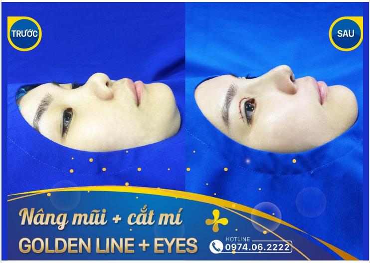 Kết thúc ca mổ cả bác sĩ, ekip và khách hàng đều cười vui. Thành quả sau 60 phút nâng mũi Golden Line kết hợp cắt mí Golden Eyes không phụ sự kỳ vọng và mong đợi của bạn gái.