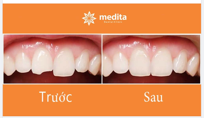 KHẮC PHỤC RĂNG SỨT MẺ