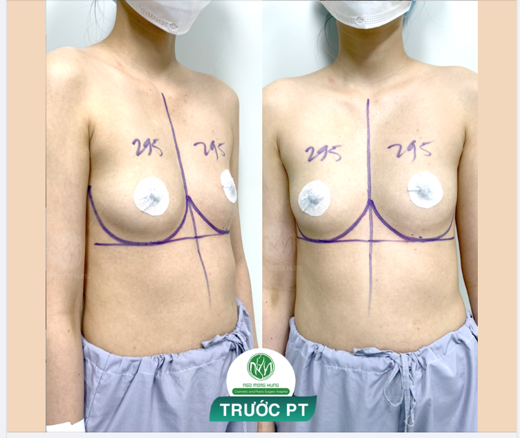 KHẮC PHỤC VÒNG 1 NHỎ VỚI TÚI ĐỘN 295CC