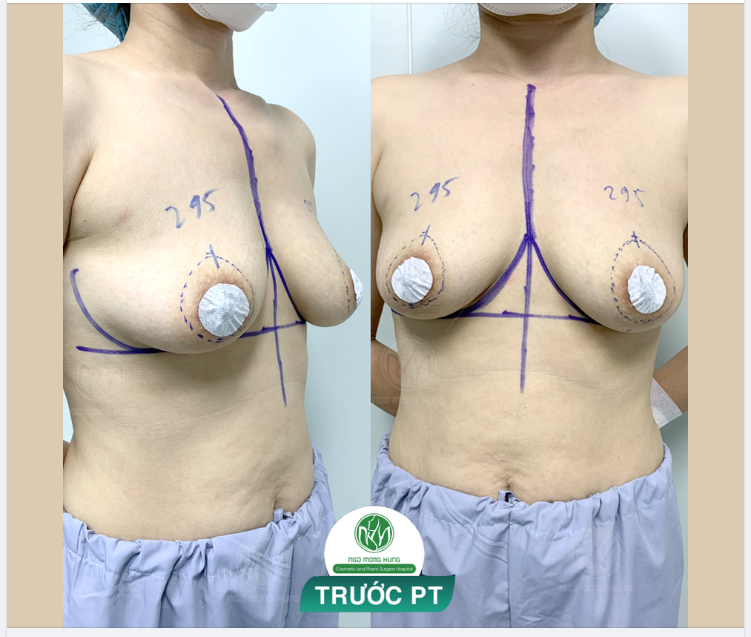 KHẮC PHỤC VÒNG 1 SA TRỄ, QUẦNG V.Ú TO